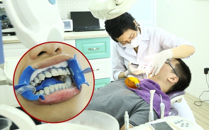 Chịu đựng những điều này nhưng có hàm răng trắng như sứ, bạn có chấp nhận không?