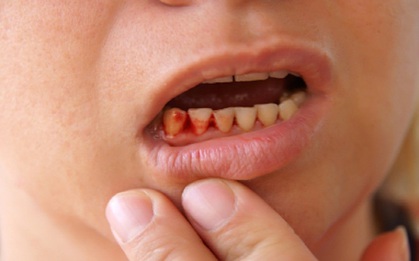 Cơ thể báo động bệnh gì khi bị chảy máu chân răng?