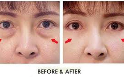 Vừa xoá bọng mắt, vừa tăng thị lực chỉ nhờ tuân thủ 6 mẹo cực nhỏ sau