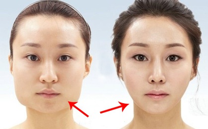 Đập xương hàm thành 3 ở Hàn Quốc và những chuẩn mực làm đẹp khác người của các nước