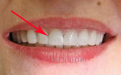 3 trường hợp nhất định không được niềng răng