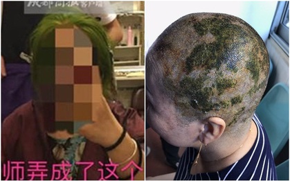 Nhuộm tóc 4 lần trong 7 tiếng để có màu xanh lá, người phụ nữ bị sốc phản vệ và cái kết không mong muốn