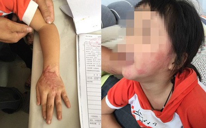 Bé gái 5 tuổi bị bỏng vì điện thoại phát nổ trong lúc ngủ, công ty điện thoại phớt lờ