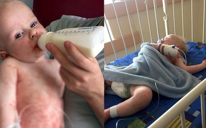 Bé trai 16 tháng tuổi suýt mất mạng vì nhiễm loại virus nguy hiểm chỉ sau 1 nụ hôn của người lớn