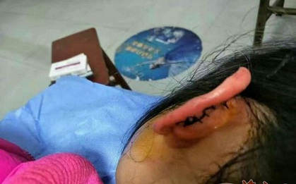 Bé gái lớp 2 bị cô giáo véo đứt tai vì chưa làm bài tập