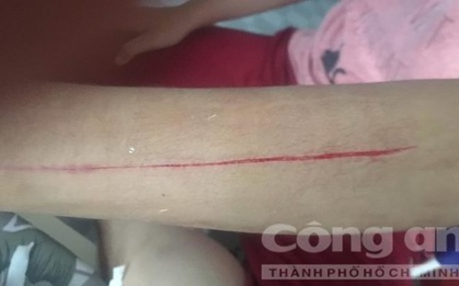 Nữ sinh lớp 10 bị bạn dùng lưỡi lam rạch tay