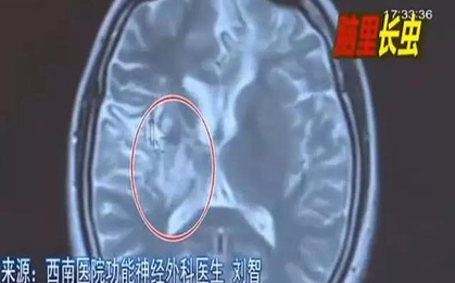 Toàn thân đau ê ẩm, cô gái sốc nặng khi phát hiện có giun sinh sống trong não mình suốt 4 năm trời