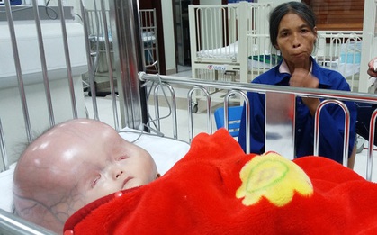 Vụ bé trai có cái đầu to khác lạ bị bố bỏ mẹ con đi lấy vợ khác: Tiên lượng xấu, gia đình xin về