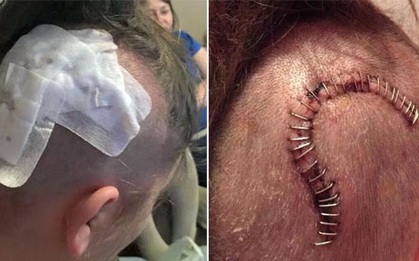 Chỉ 1 năm sau khi đặt que cấy tránh thai, cô gái trẻ bị tăng áp lực trong não, nhìn mờ và suýt tử vong