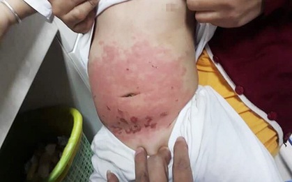 Mẹ bôi dầu khuynh diệp trực tiếp lên người con quá nhiều, bé gái 14 tháng tuổi bị bỏng da bụng