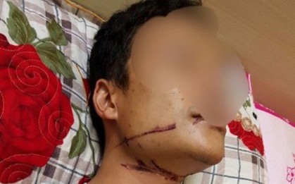 HI HỮU: Suýt mất mạng vì bị dây cáp viễn thông siết vào cổ?