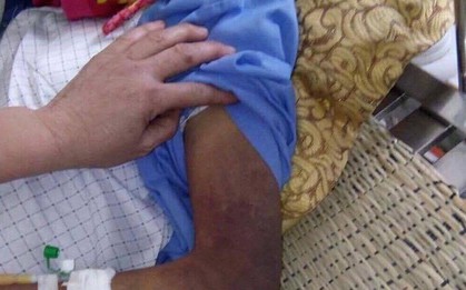 Con trai đánh bố gãy xương sườn, mẻ xương chân và bánh chè