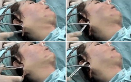 Xem quy trình phát rợn này, dám chắc bạn sẽ chẳng dám đi phẫu thuật căng da mặt nữa