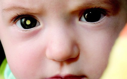 Người phụ nữ thấy sự phản chiếu kỳ lạ trong mắt con của người bạn, cô thúc giục bạn cho con đi khám và kết quả đáng sợ