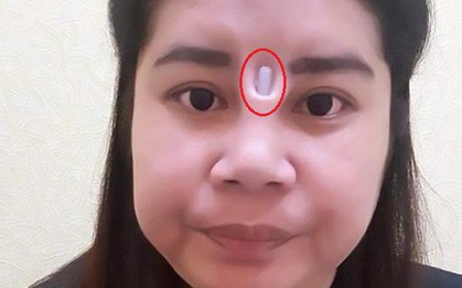 Quy trình phẫu thuật nâng mũi như thế nào mà bệnh nhân có thể lòi cả silicone?