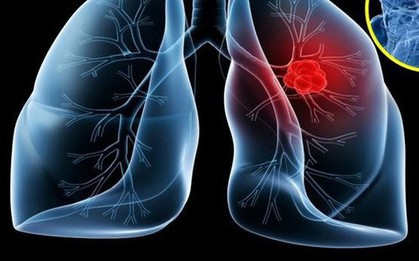 Dấu hiệu "lặng lẽ" của bệnh ung thư phổi không ai được xem thường