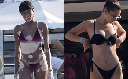 Người mẫu bạch biến mặc bikini khoe làn da loang lổ độc đáo, làm lu mờ cả Bella Hadid
