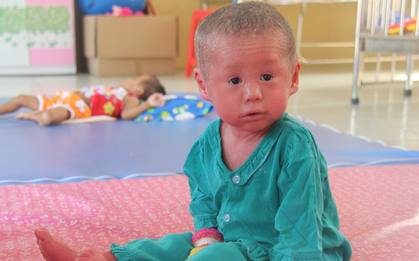 Bé Bích 20 tháng tuổi người đầy vẩy ngứa như da trăn nay đã biết đi, bi bô tập nói