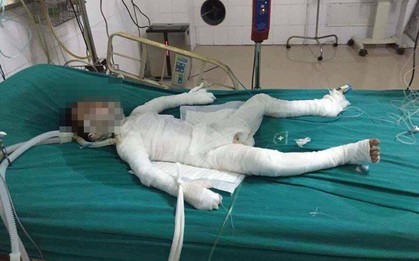 Cháu bé 6 tuổi bị bố dượng nhốt trong nhà, tẩm xăng đốt đang trong tình trạng nguy kịch
