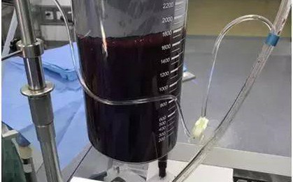 Tưởng đau dạ dày, cô gái không ngờ suýt mất mạng vì vỡ nang hoàng thể buồng trứng: Lời cảnh báo cho chị em hay bị đau bụng