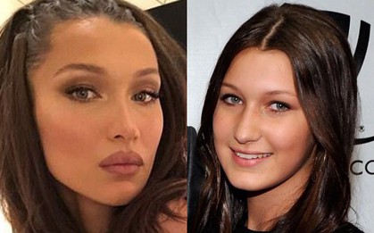 Chối bay chối biến phẫu thuật thẩm mỹ, nhưng Bella Hadid lại lộ môi sưng to như vừa bơm thêm