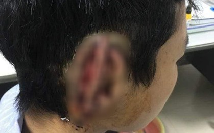 Nam sinh cắn đứt rồi nuốt tai của bạn vào bụng âm tính với ma túy?