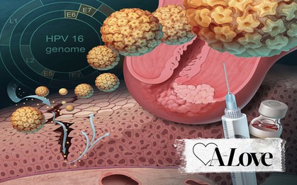 Sùi mào gà - chứng bệnh cực kỳ dễ lây khi sex không an toàn và có thể đeo bám cả một đời