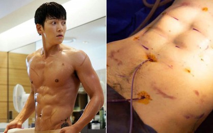 Trào lưu phẫu thuật thẩm mỹ mới: Body 6 múi sexy không cần phải tập cũng có!