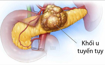 Đây là những dấu hiệu ung thư tuyến tụy mà cơ thể đang cố cảnh báo nhưng lại bị bạn lờ đi