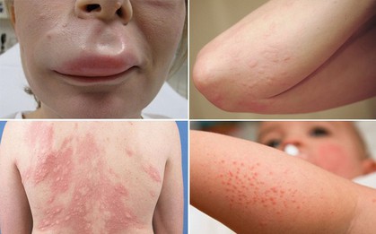 Cẩn thận kẻo trời lạnh quá sẽ khiến bạn mắc phải chứng dị ứng có thể gây chết người này