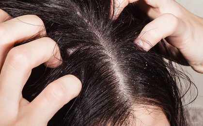 Thói quen gội đầu ai cũng mắc phải vào mùa đông mà không hề biết nó có hại cho sức khoẻ