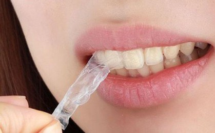Có nên làm trắng răng "thần tốc" bằng miếng dán?