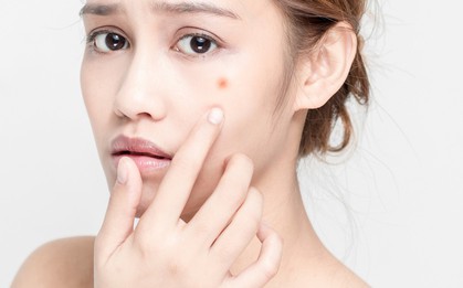Thanh xuân phơi phới không lo mụn, sẹo
