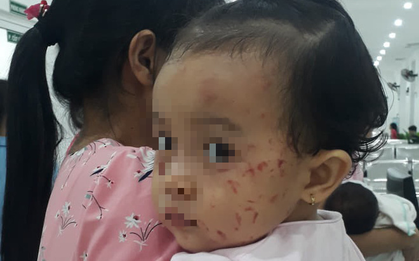 Xôn xao hình ảnh mặt bé gái 20 tháng tuổi đầy vết trầy xước khi đi nhà trẻ