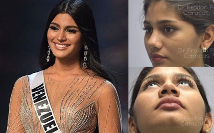 Được khen đẹp như Kim Kardashian, Á hậu Miss Universe 2018 bị khui lại ảnh quá khứ khác một trời một vực