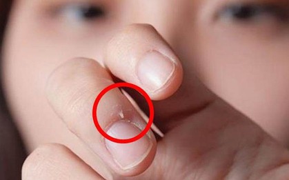 Thấy móng tay có 6 dấu hiệu này thì đừng nên chủ quan xem thường