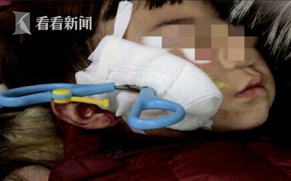Bé 2 tuổi bị chiếc kéo đâm xuyên má chỉ vì một phút lơ là của người lớn