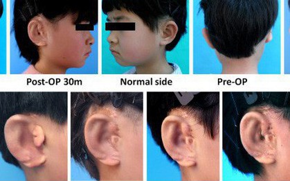 5 ca ghép tai đầu tiên trên thế giới, thực hiện theo phương pháp "copy/paste"