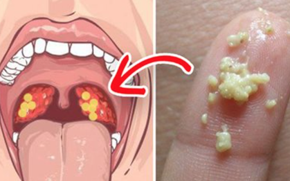 1/4 dân số đang có "dị vật" này trong miệng và những dấu hiệu khiến nó trở nên kinh khủng