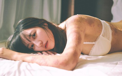 Bộ hình của nữ họa sĩ bị viêm da cơ địa và thông điệp "Con gái, cứ kiên cường là xinh đẹp nhất"