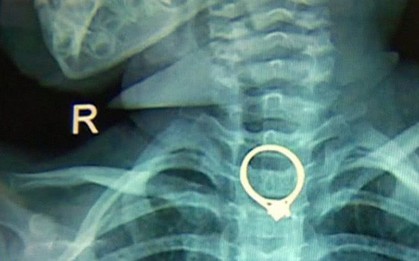 Vô tư đưa nhẫn đính hôn cho con gái 2 tuổi chơi, bà mẹ suýt "lấy mạng" con trong chốc lát