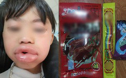 Hoang mang thông tin bé trai sưng húp môi sau khi ăn kẹo dẻo ở cổng trường