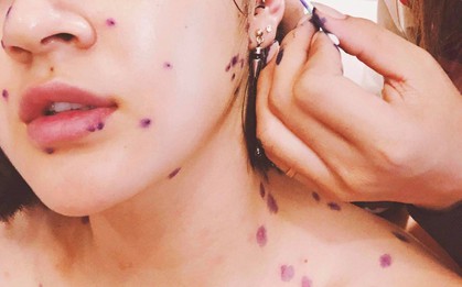 Mùa hè đến rồi, cẩn thận không mắc bệnh thủy đậu giống như Bảo Anh