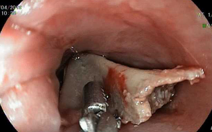 Vừa xem tivi vừa ăn đùi gà, bé gái 13 tuổi ở Bình Dương suýt chết vì nuốt xương
