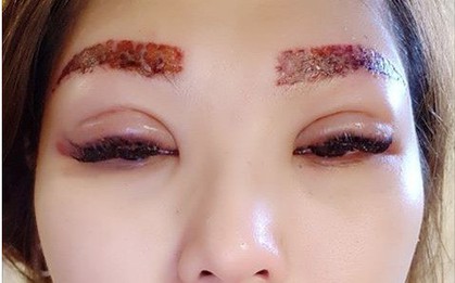 Muốn xăm mí mắt, lông mày cho giống Hồ Ngọc Hà, ai ngờ bị hỏng, cô gái lại chịu bao đau đớn để xóa xăm