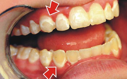 9 dấu hiệu cơ thể báo động cần detox cơ thể ngay