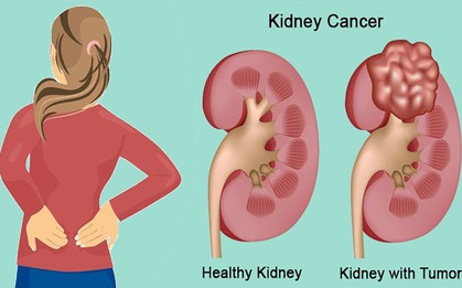 6 dấu hiệu cảnh báo bạn có nguy cơ mắc bệnh ung thư thận