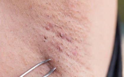 Mùa hè đến rồi, cứ vô tư nhổ lông nách bằng nhíp coi chừng gặp những hậu quả sau