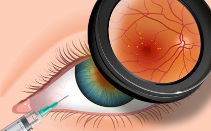 4 căn bệnh ở mắt nếu không chữa trị sớm có thể dẫn tới nguy cơ mù lòa