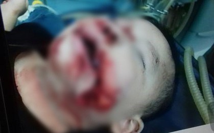 Hà Nội: Bé trai 21 tháng tuổi bị chó dại cắn rách mặt, hoàn cảnh gia đình khó khăn